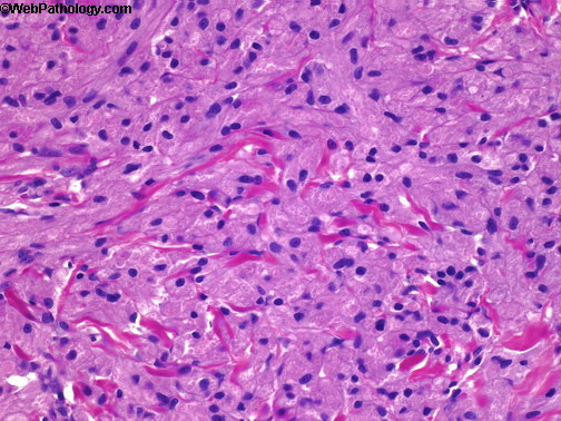 Scrotum_Granular Cell Tumor4.jpg
